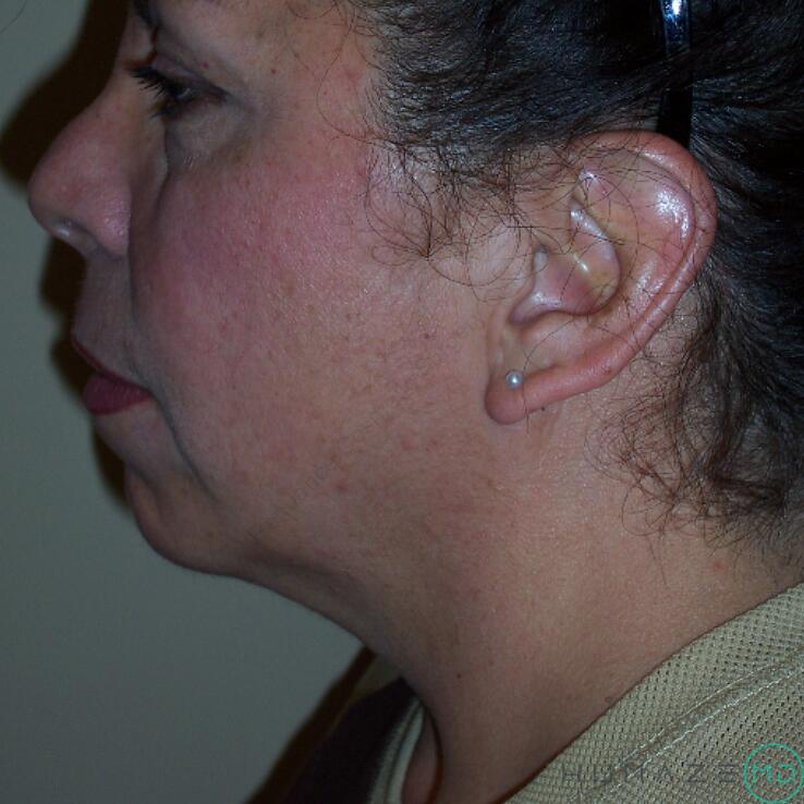 Liposuction Before & After Image