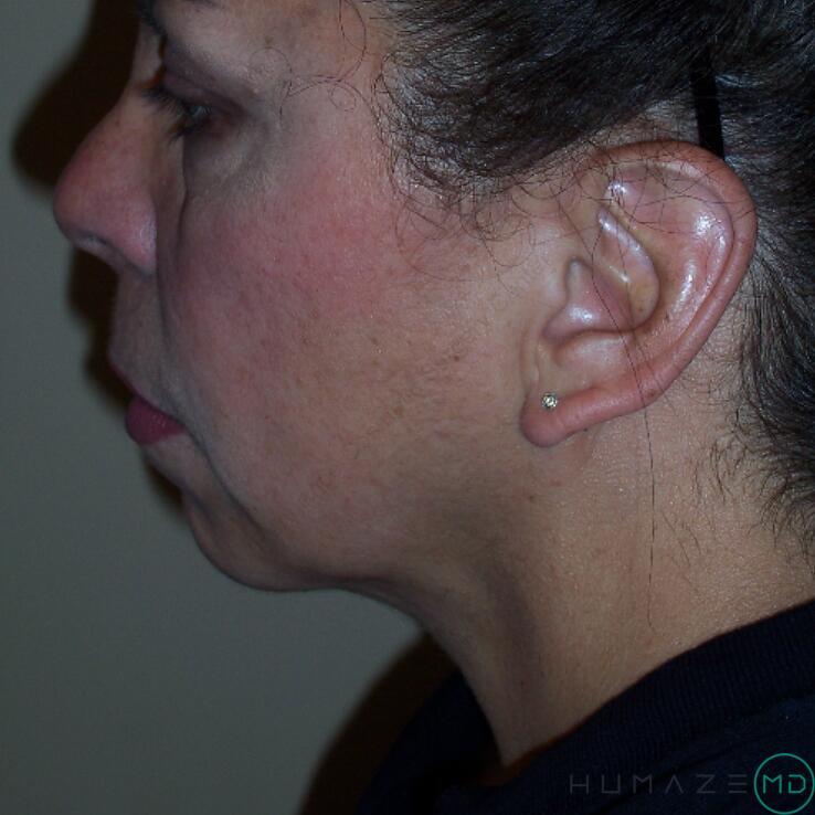 Liposuction Before & After Image