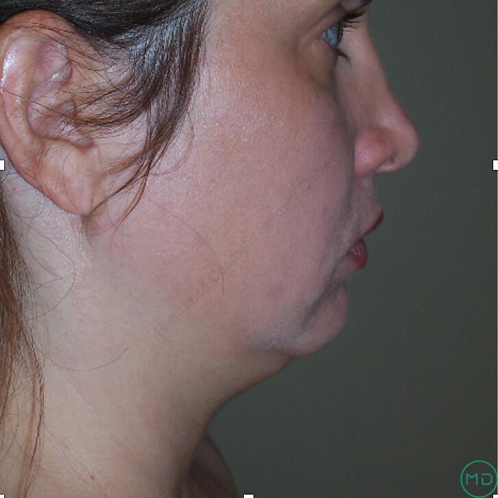 Liposuction Before & After Image