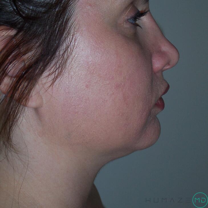 Liposuction Before & After Image