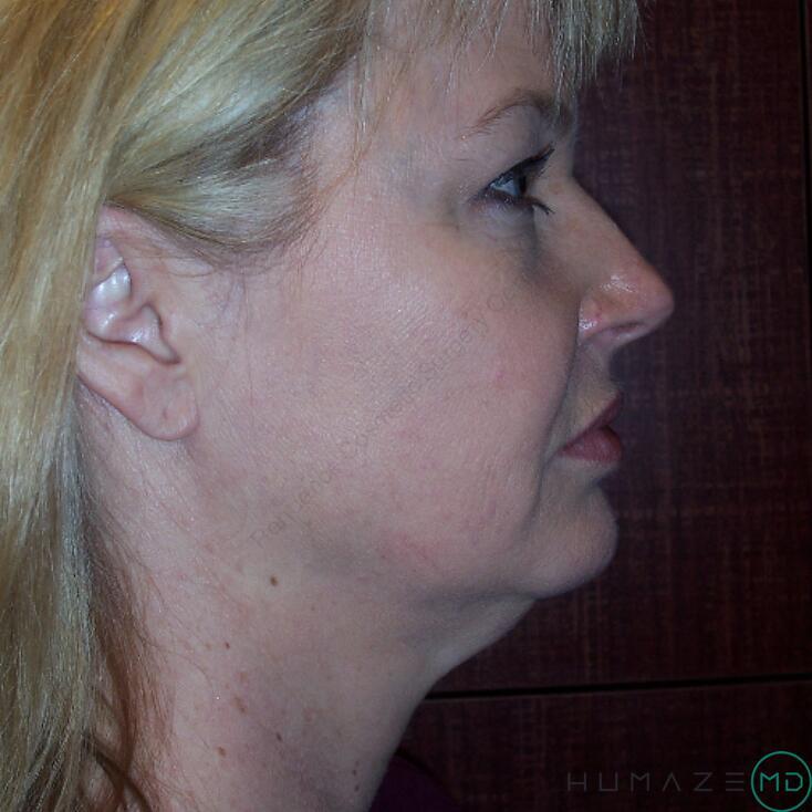 Liposuction Before & After Image