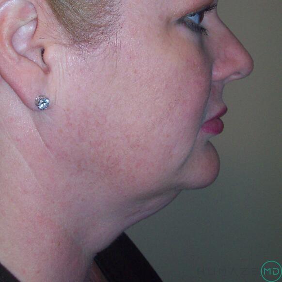 Liposuction Before & After Image