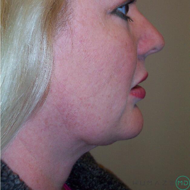 Liposuction Before & After Image