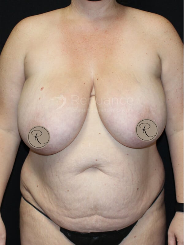 Mommy Makeover Before & After Image