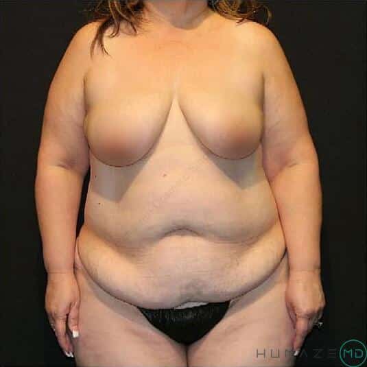 Mommy makeover Before & After Image