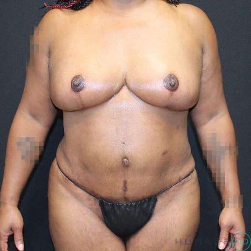 Mommy makeover Before & After Image