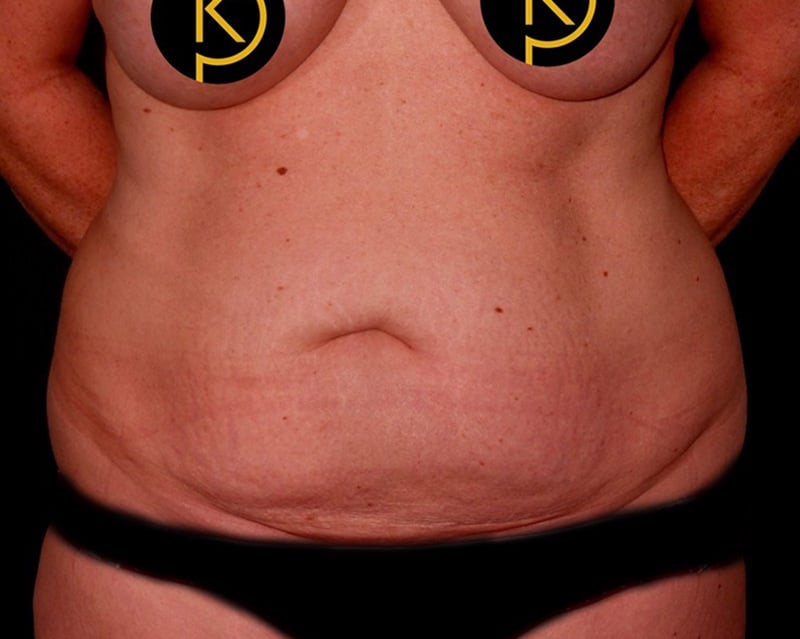 Tummy Tuck Before & After Image