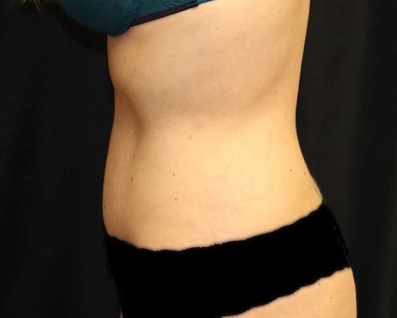 Tummy Tuck Before & After Image