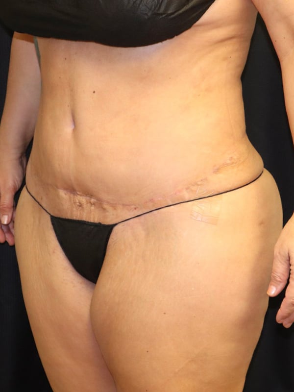 Tummy Tuck Before & After Image