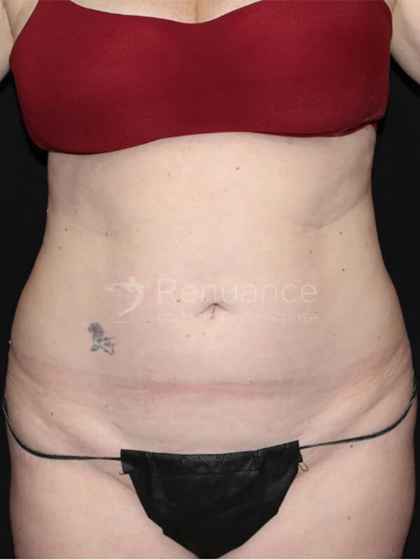 Tummy tuck Before & After Image