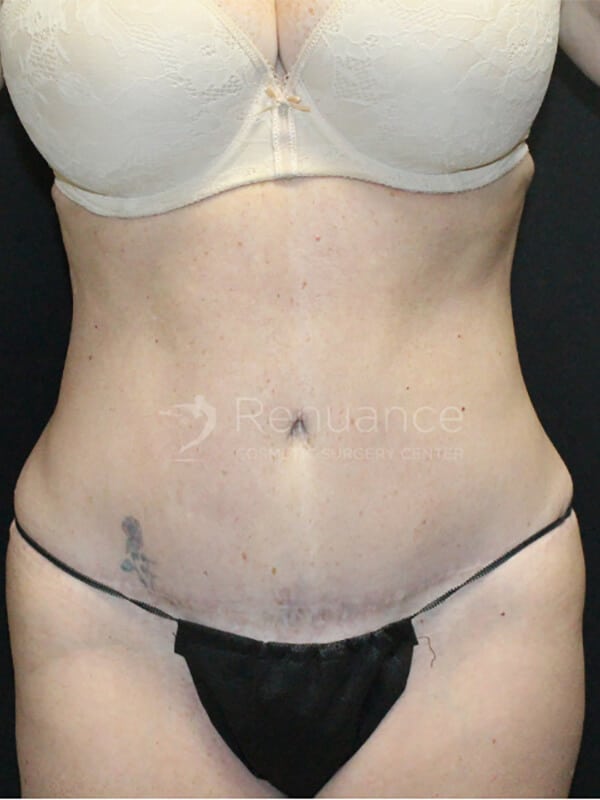 Tummy tuck Before & After Image