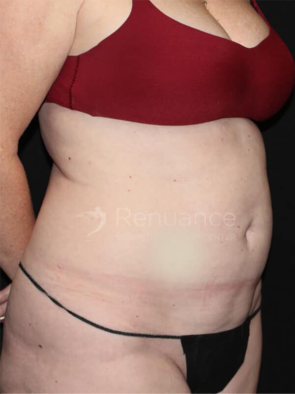 Tummy tuck Before & After Image