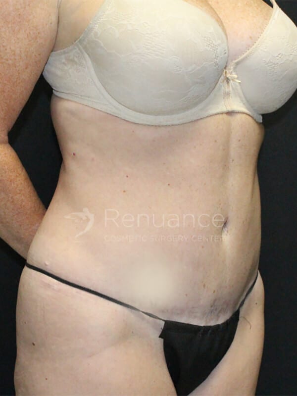 Tummy tuck Before & After Image