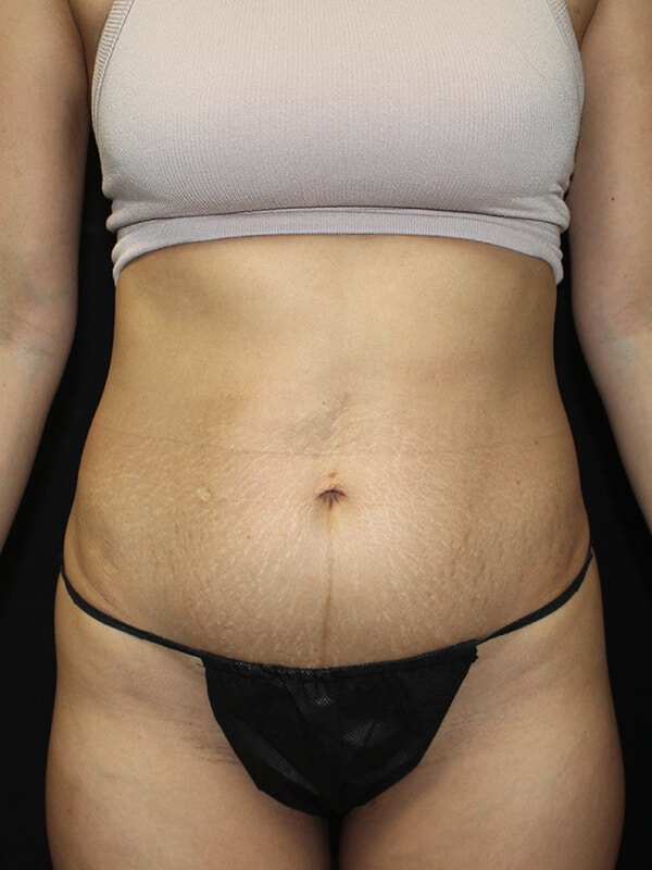 Tummy tuck Before & After Image