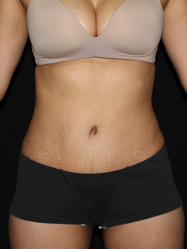 Tummy tuck Before & After Image
