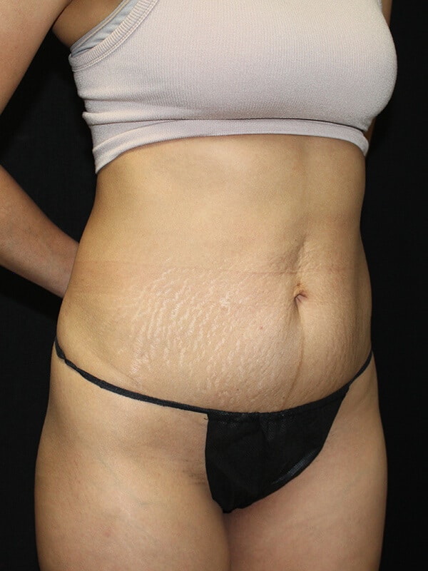 Tummy tuck Before & After Image