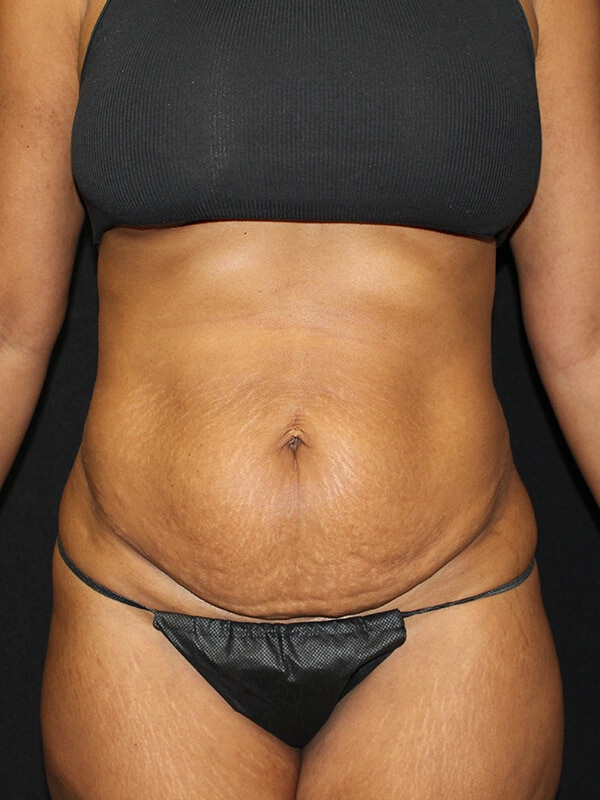 Tummy tuck Before & After Image