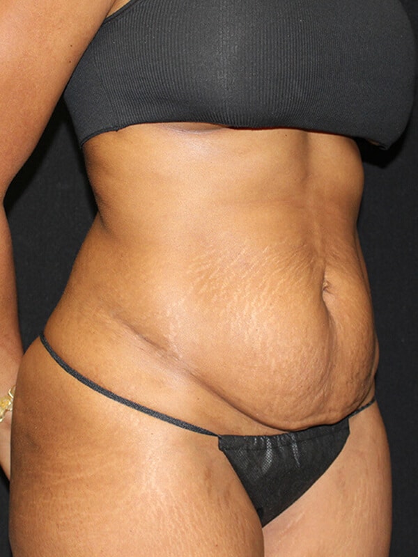 Tummy tuck Before & After Image