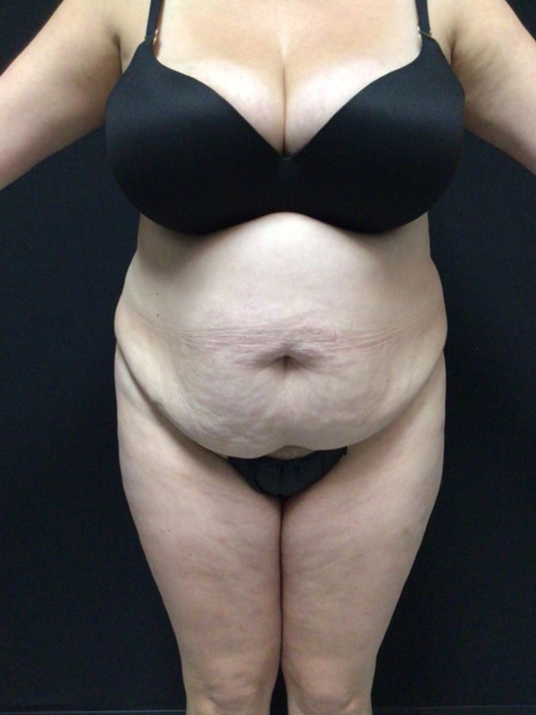 Tummy tuck Before & After Image