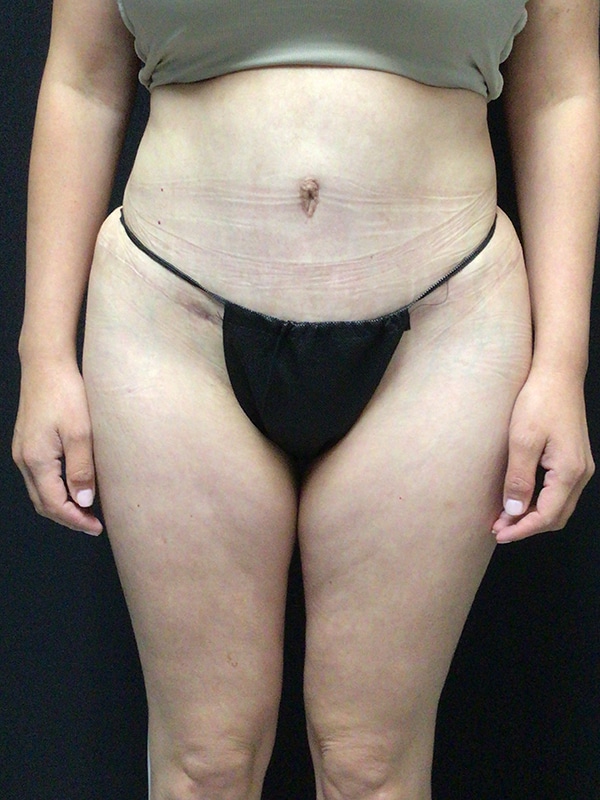 Tummy tuck Before & After Image
