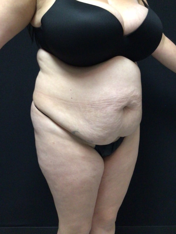 Tummy tuck Before & After Image