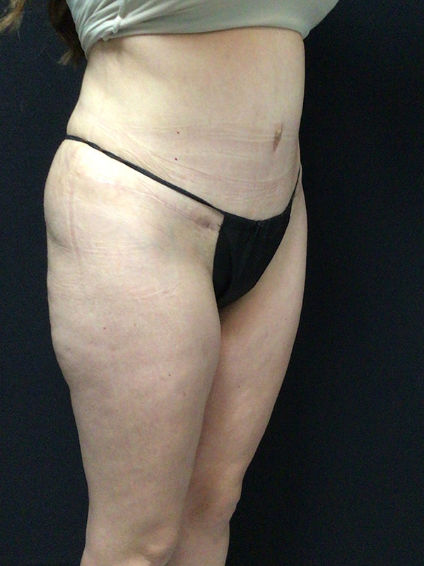 Tummy tuck Before & After Image