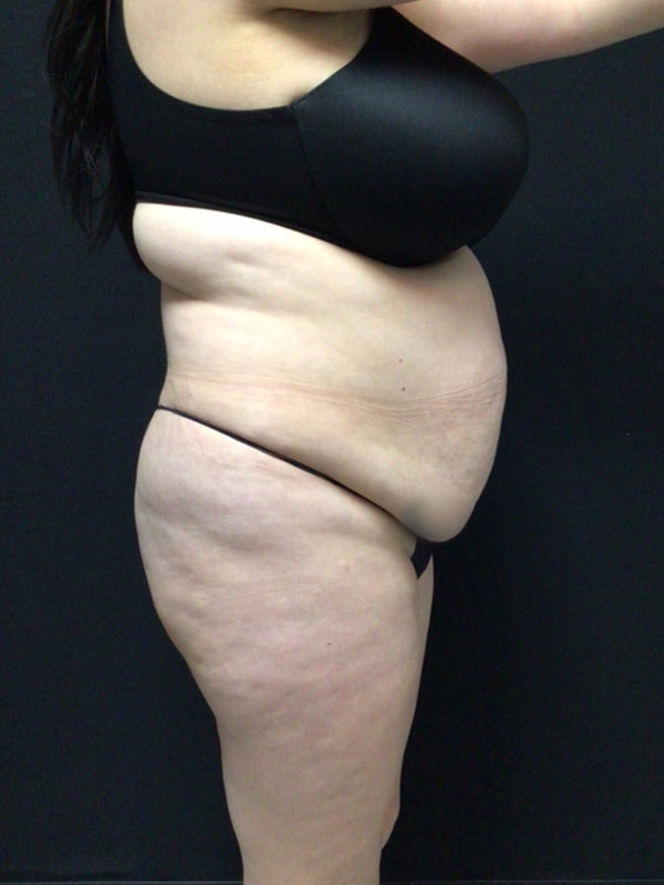 Tummy tuck Before & After Image