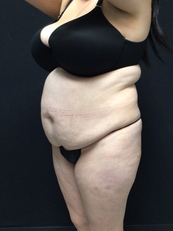 Tummy Tuck Before & After Image