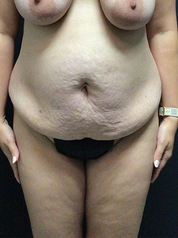 Tummy tuck Before & After Image