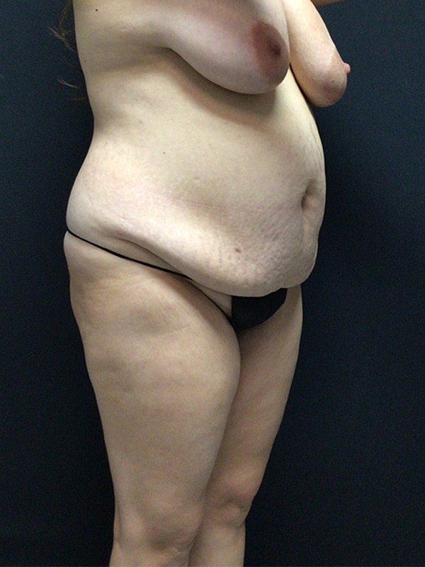 Tummy tuck Before & After Image