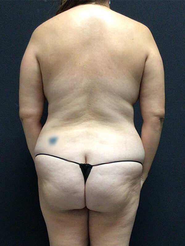 Tummy Tuck Before & After Image