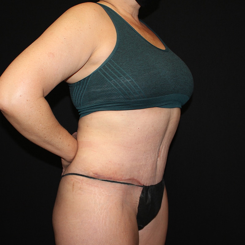 Tummy tuck Before & After Image