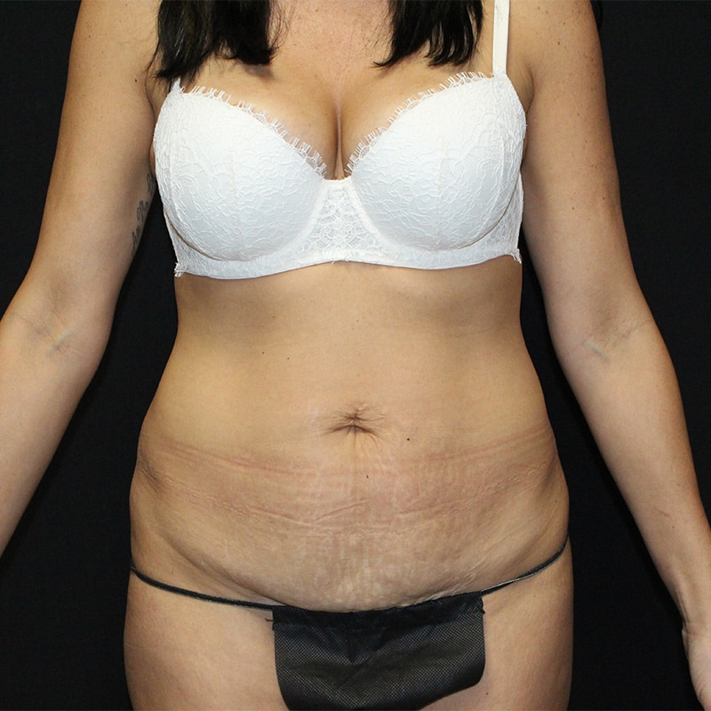 Tummy tuck Before & After Image