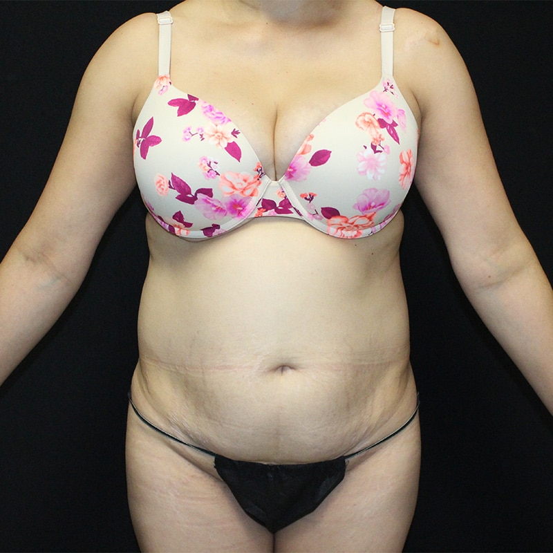 Tummy tuck Before & After Image