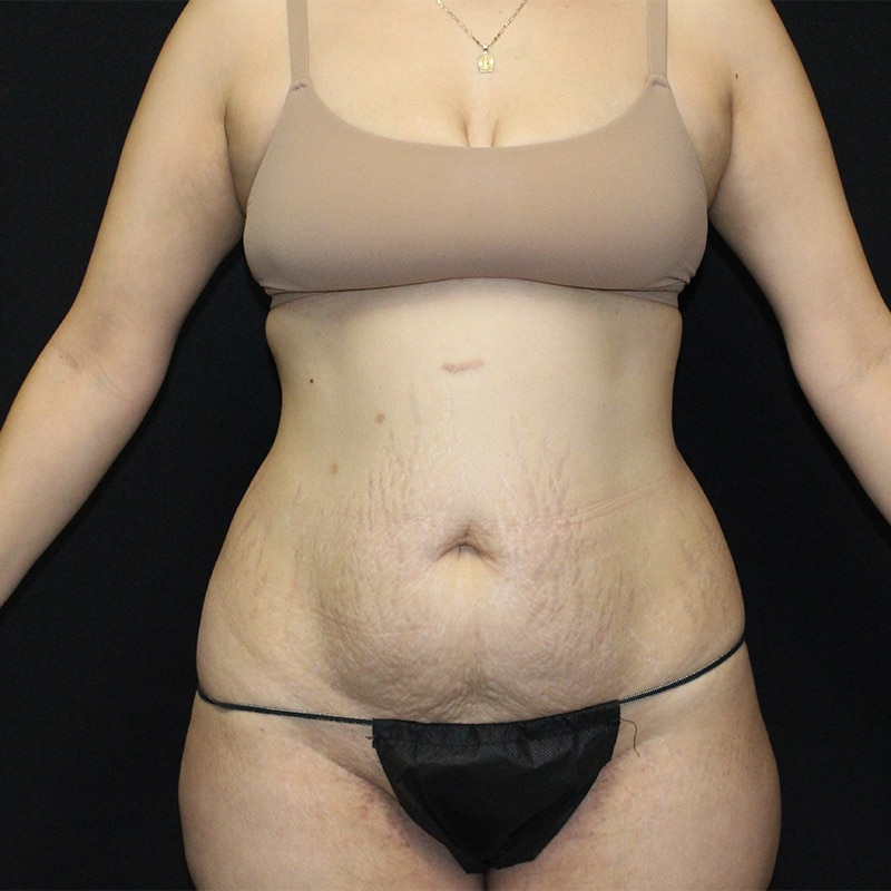Tummy tuck Before & After Image