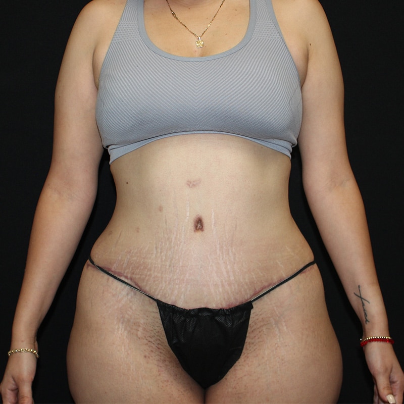 Tummy tuck Before & After Image