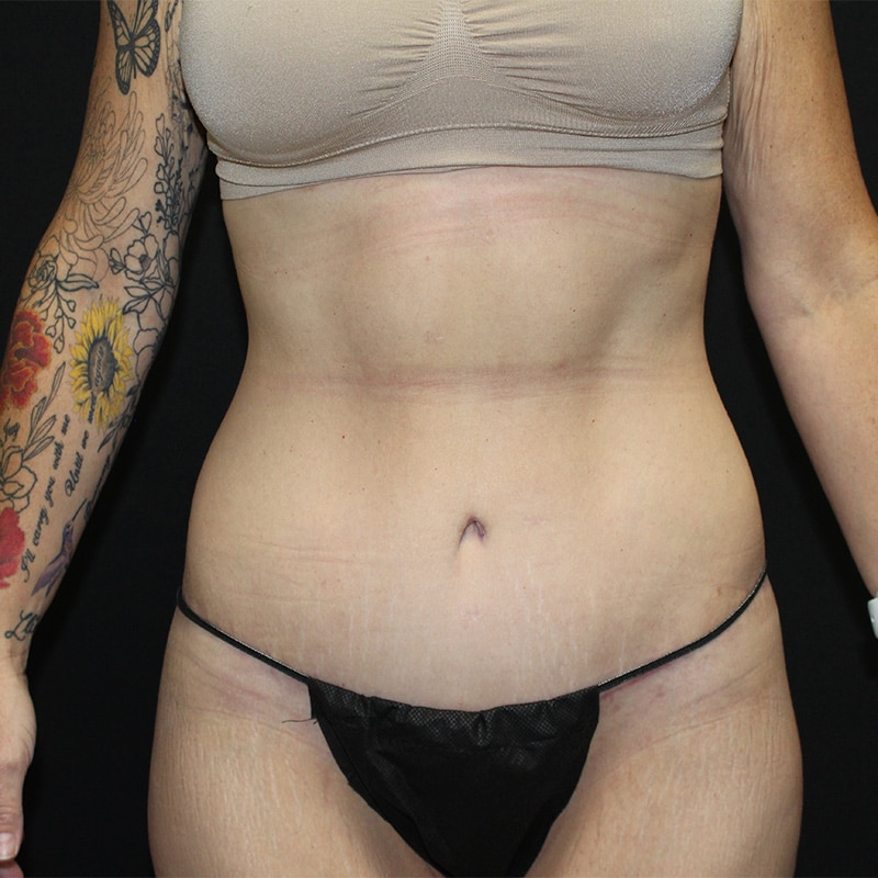 Tummy tuck Before & After Image