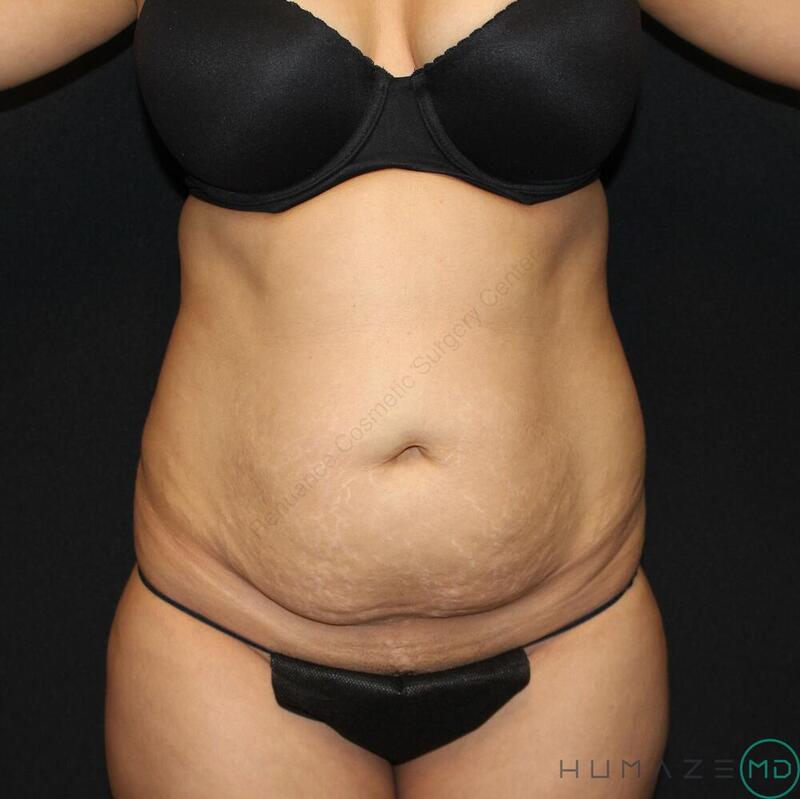 Tummy tuck Before & After Image