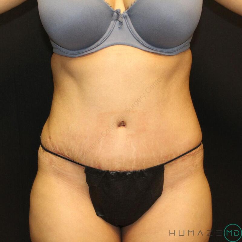 Tummy tuck Before & After Image