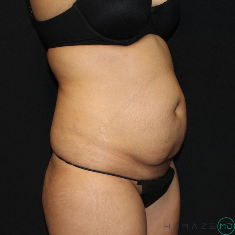 Tummy tuck Before & After Image