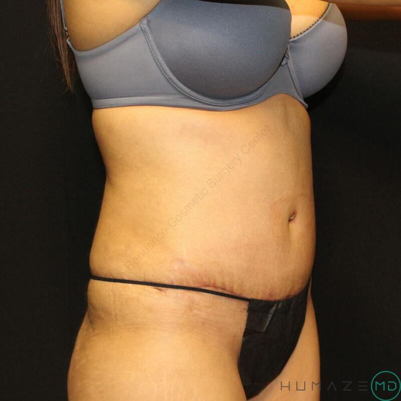 Tummy tuck Before & After Image
