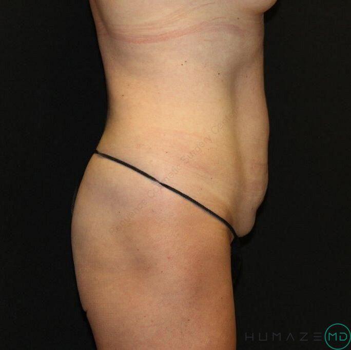 Tummy tuck Before & After Image