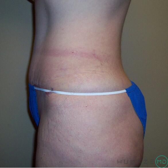 Tummy tuck Before & After Image