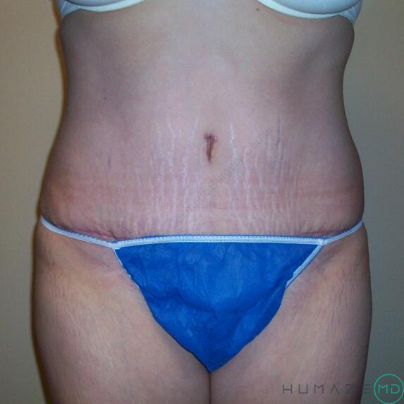 Tummy tuck Before & After Image