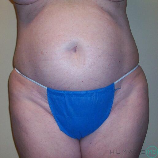 Tummy tuck Before & After Image