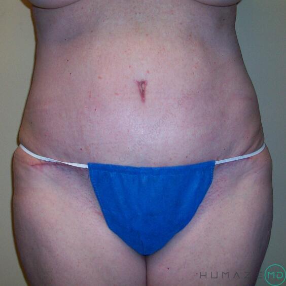 Tummy tuck Before & After Image