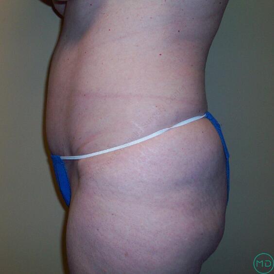 Tummy tuck Before & After Image
