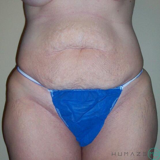 Tummy tuck Before & After Image