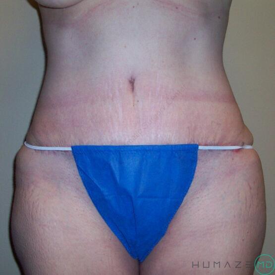 Tummy tuck Before & After Image