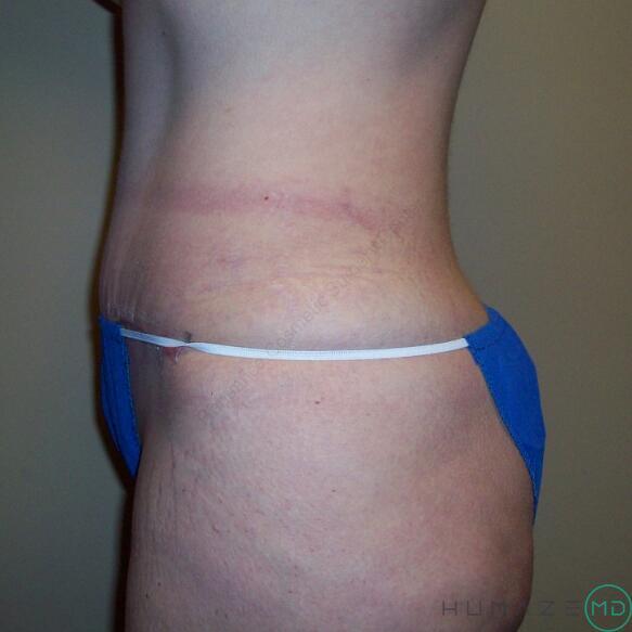 Tummy tuck Before & After Image